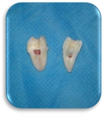 Sectioned tooth