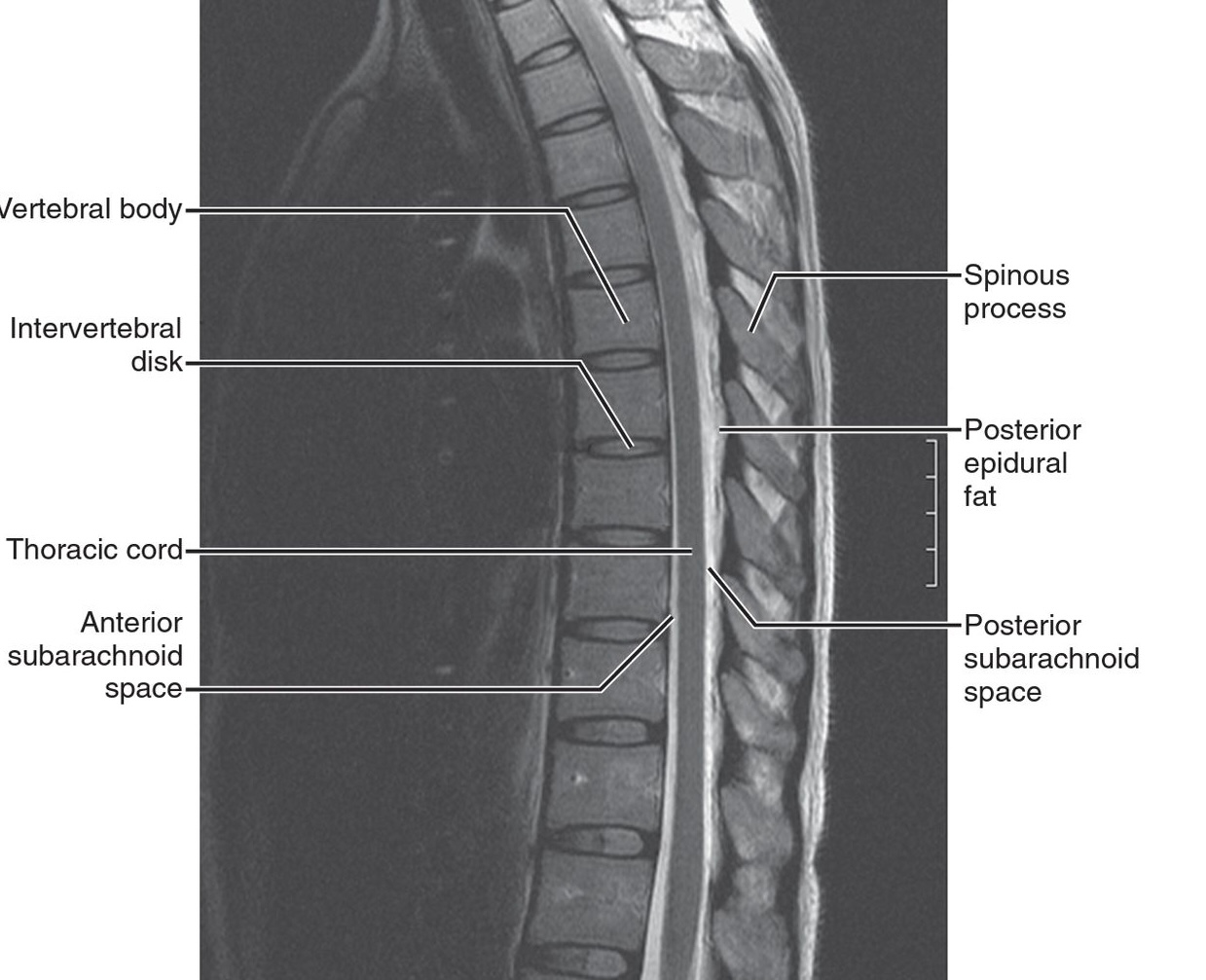 Saggital gradient echo study of the thoracic spine. The cord is enlarged from T9 to T12, outlined by high signal CSF
