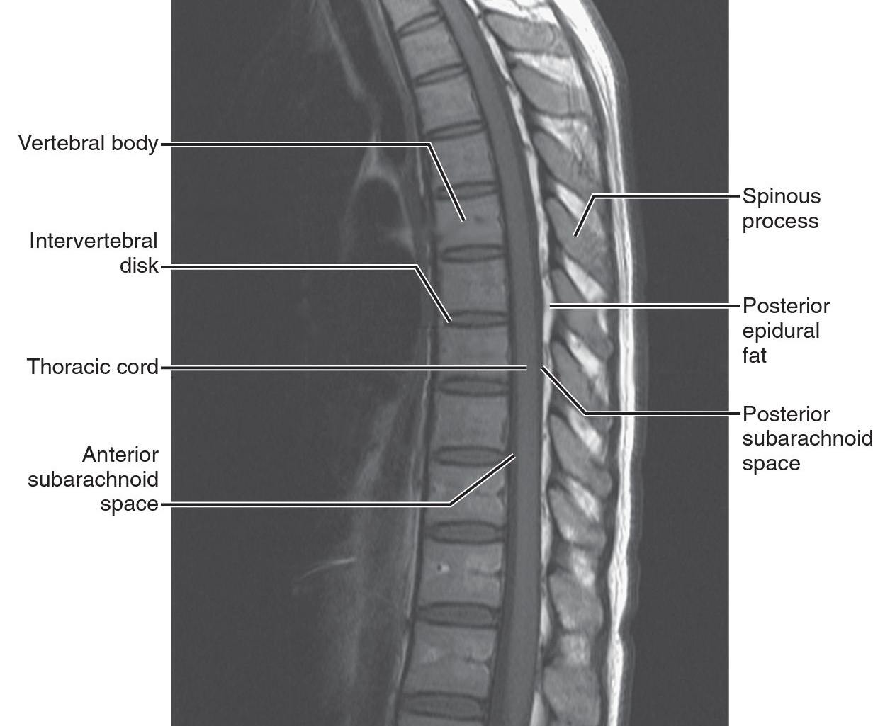 Saggital T1 MRI of thoracic spine. There is more cerebrospinal fluid (CSF) posteriorly in the thoracic area