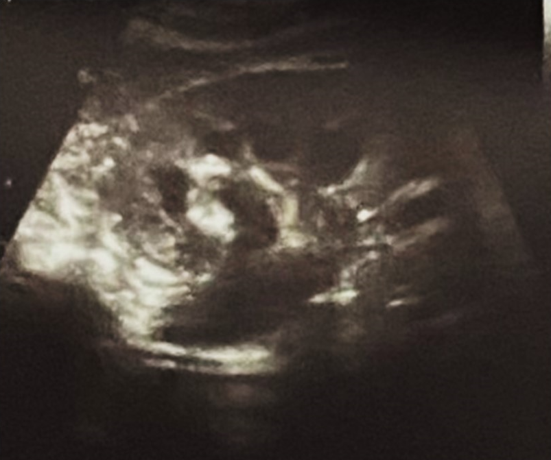 Ultrasonography showing dilated left pelvis calyceal system.