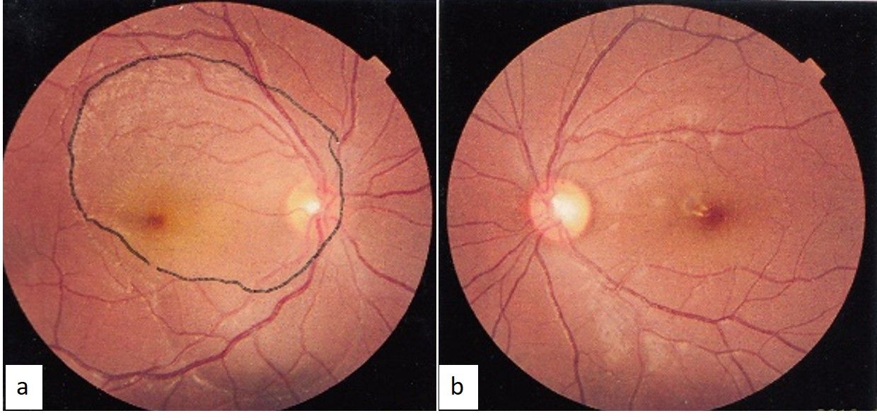 a) Fundus image of right eye showing well delineated areas ofsubretinal fluid (denoted by * and **). b) Fundus image of the left eye which showed no pathological changes.