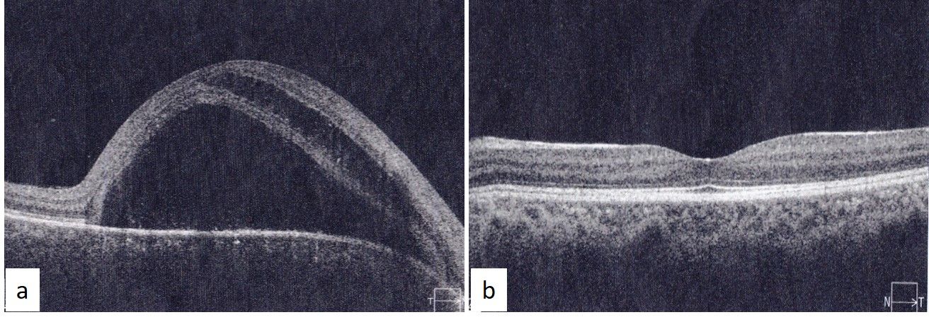a) SD-OCT image of right eye showingsubfoveal neurosensory detachment extending to the optic nerve nasally along with retinal schisis. b) SD-OCT image of left eye showing normal foveal contour and healthy photoreceptor layers.
