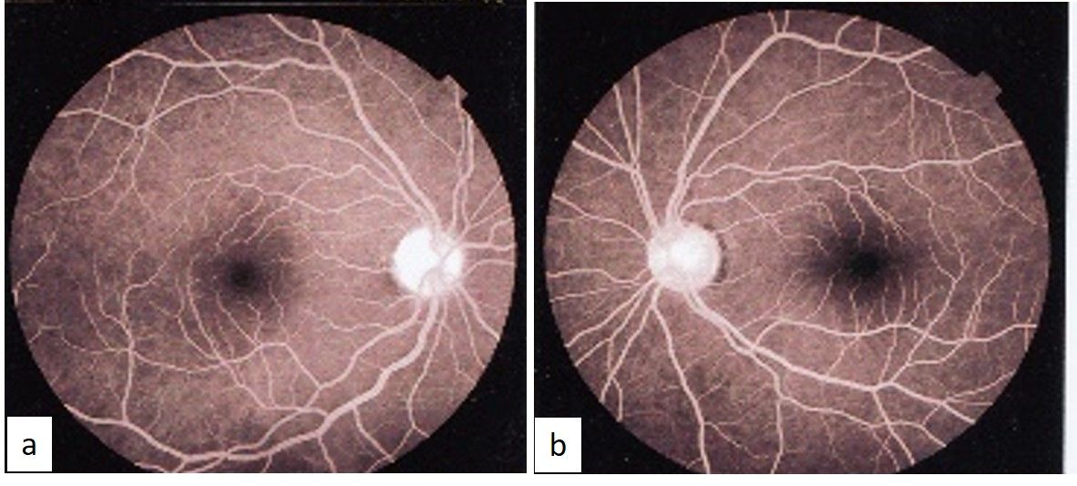 (a, b) Fundus fluorescein angiography of right and left eyes in late A-V phase showing no abnormal pooling or leaking.