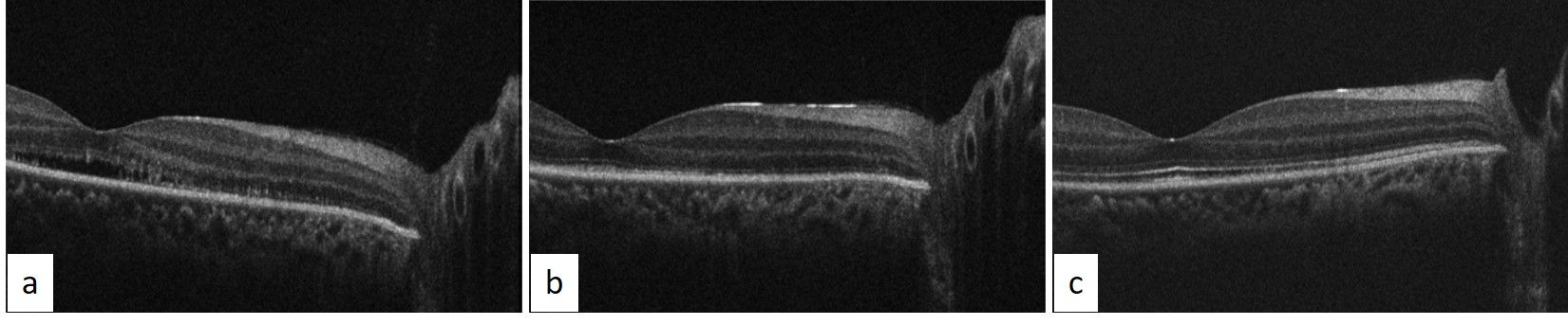a) SD-OCT image of right eye at first follow-up after 2 weeks showing resolved retinalschisis and minimal subretinal fluid with damaged photoreceptor layers subfoveally and nasal to fovea extending to the disc. b) SD-OCT image of right eye at second follow-up, 2 weeks after the first follow-up showing resolved subretinal fluid, regenerating phtotoreceptor layers. c) SD-OCT image of right eye at third follow-up, 1 month after the second follow-up showing resolved subretinal fluid and regenerated photoreceptor layers.