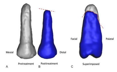 CBCT image ofroot resorption