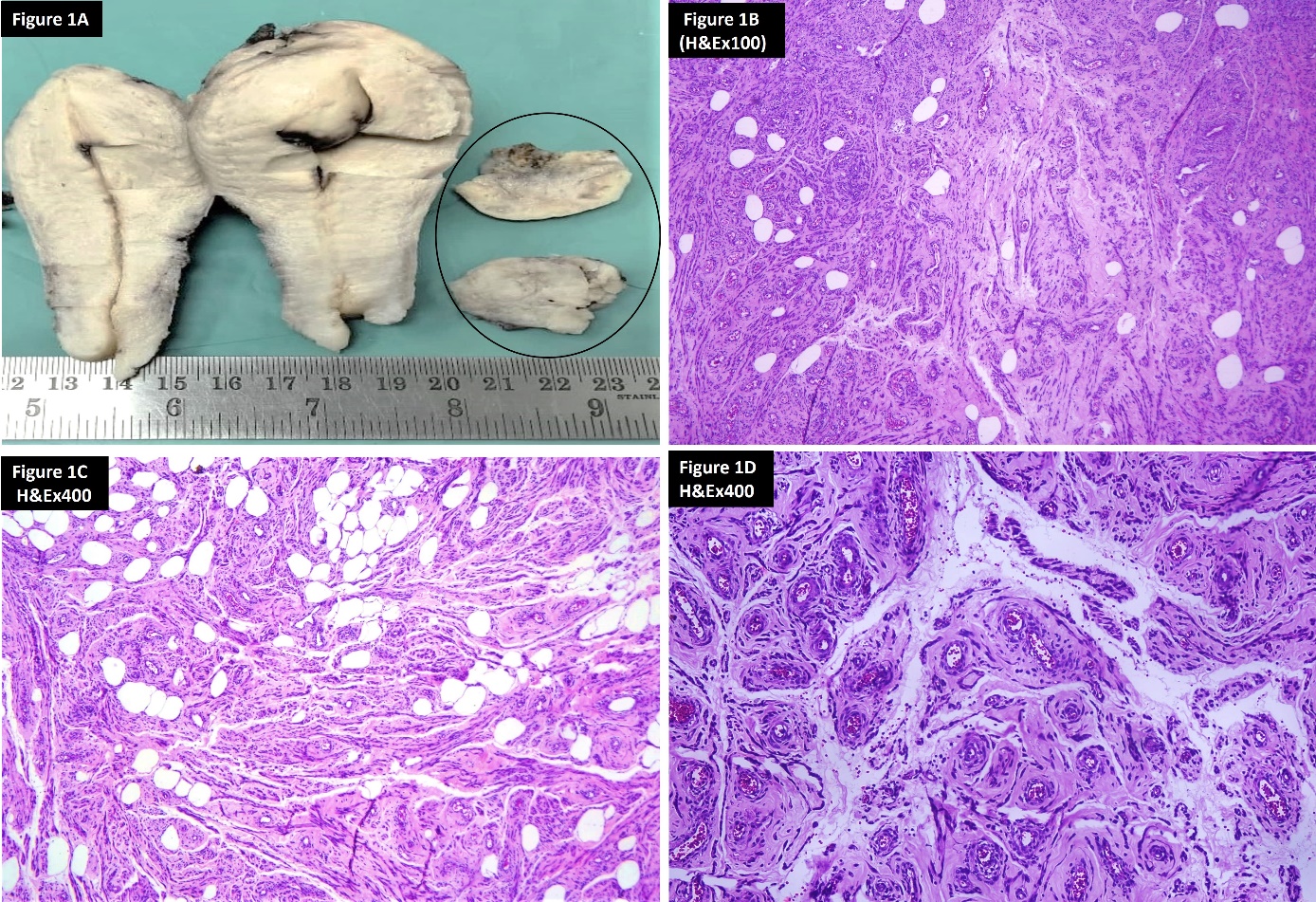 A: Hysterectomy specimen with uterine mass lesion (inside black circle); B: Histology of the lesion H&E x100; C: Histology of the lesion highlighting the adipose tissue component H&E x400; D: Histology of the lesion highlighting the blood vessel component H&E x400