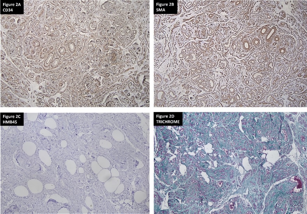 A: Anti CD 34 immunomarker positivity in vessels; B: Anti SMA immunomarker positivity in smooth muscle cells; C: Anti HMB45- Negative in tumour; D: Trichrome stain highlighting the smooth muscle cells and collagen