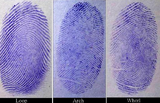 Types of dermatoglyphic patterns