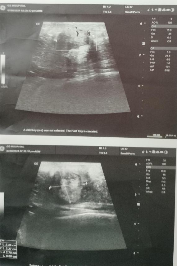 USG breast showing a well-defined mass in right breast, suggestive of Fibroadenoma.