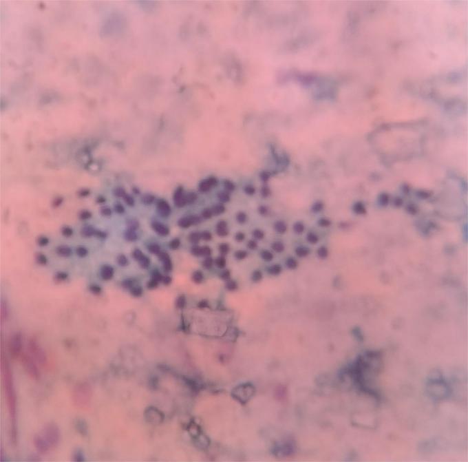 Smear showing group of benign ductal epithelial cells along with variably shaped crystals in background [Pap, 200X].