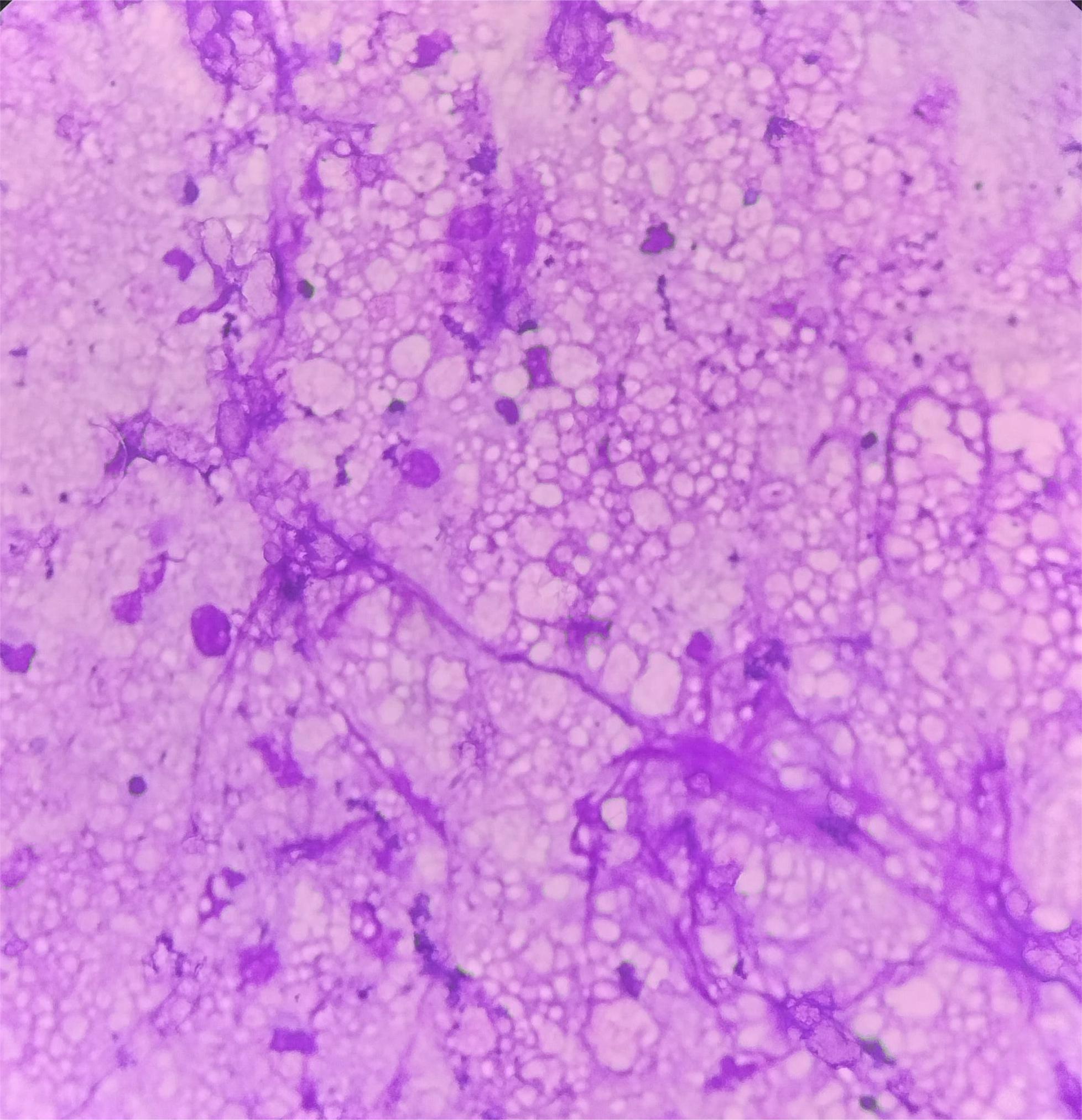 Smear showing amorphous granular proteinaceous material with frothy appearing micelles [Giemsa, 200X].