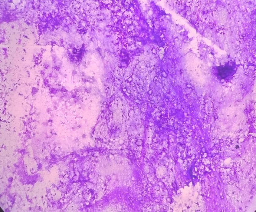 Smear showing granular amorphous background with scattered crystals [Giemsa, 100X].