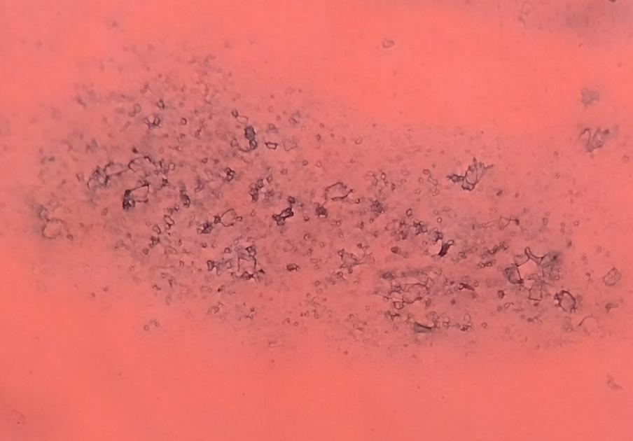 Angulated & oval shaped crystals [Giemsa, 100X].