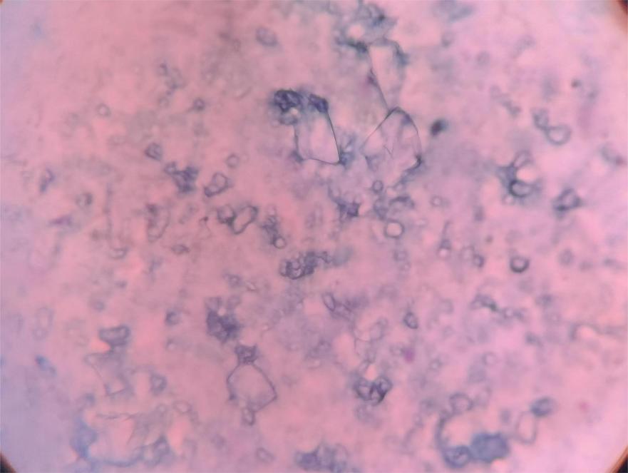 High power image showing variably sized crystals [Pap, 400X].