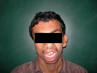 Pre op frontal view