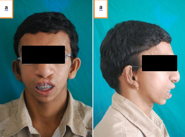 a,b: post op frontal and lateral view