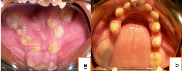 a,b Pre op intraoral view