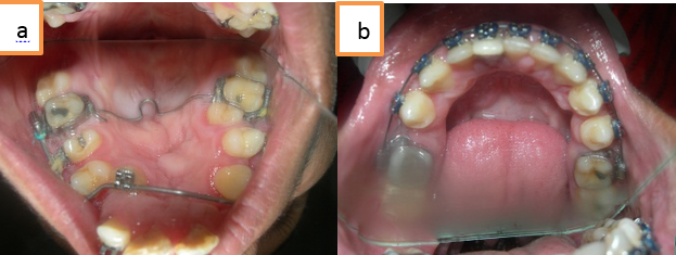 a,b: Post op intraoral views