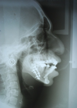 Post op Lateral Cephalogram