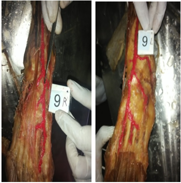 Normal course and branching pattern of Dorsalis pedis artery