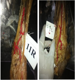 Anteriortibial artery was found on lateral side of leg