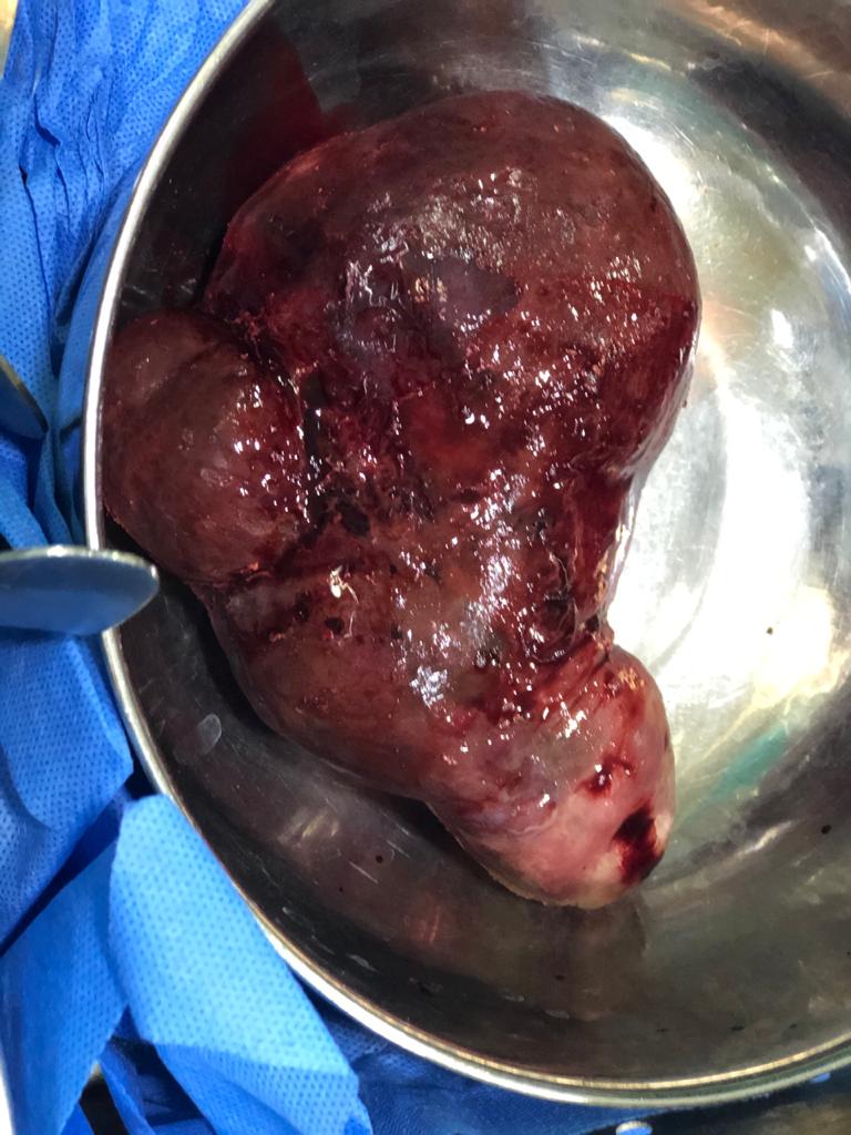 Gross appearance of submucosal polyp showing areas of hemorrhage and necrosis