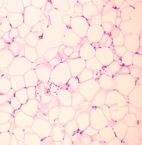 Histopathological picture it depicting mature adipose tissue admixed with collagen streaks with well-demarcated surrounding connective tissues suggesting lipoma