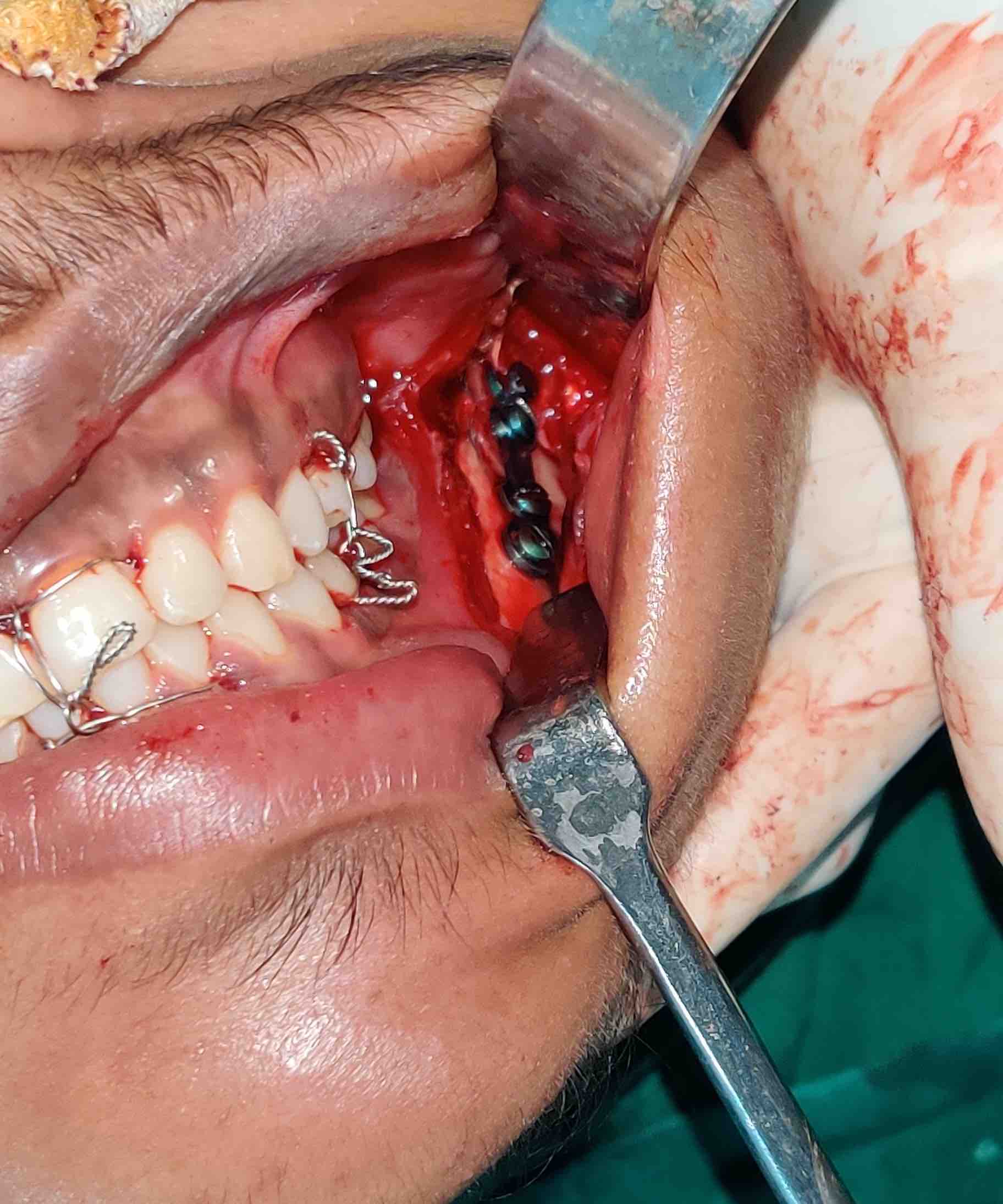 Case 2- Intra-op lateral cortical plating of fracture site