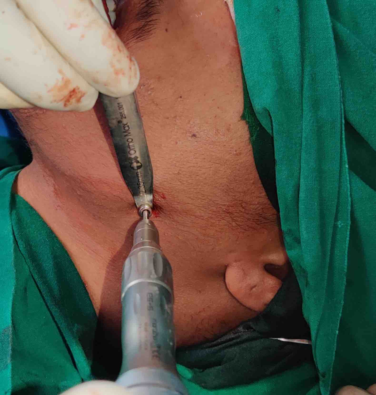 Case 2- Intra-op lateral cortical plating using trocar
