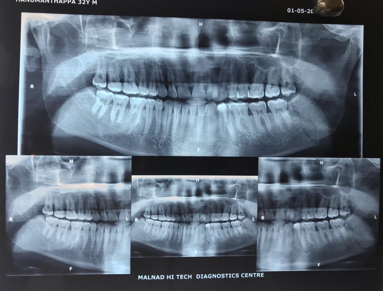 Case 1- Pre-OP orthopantomogram radiograph