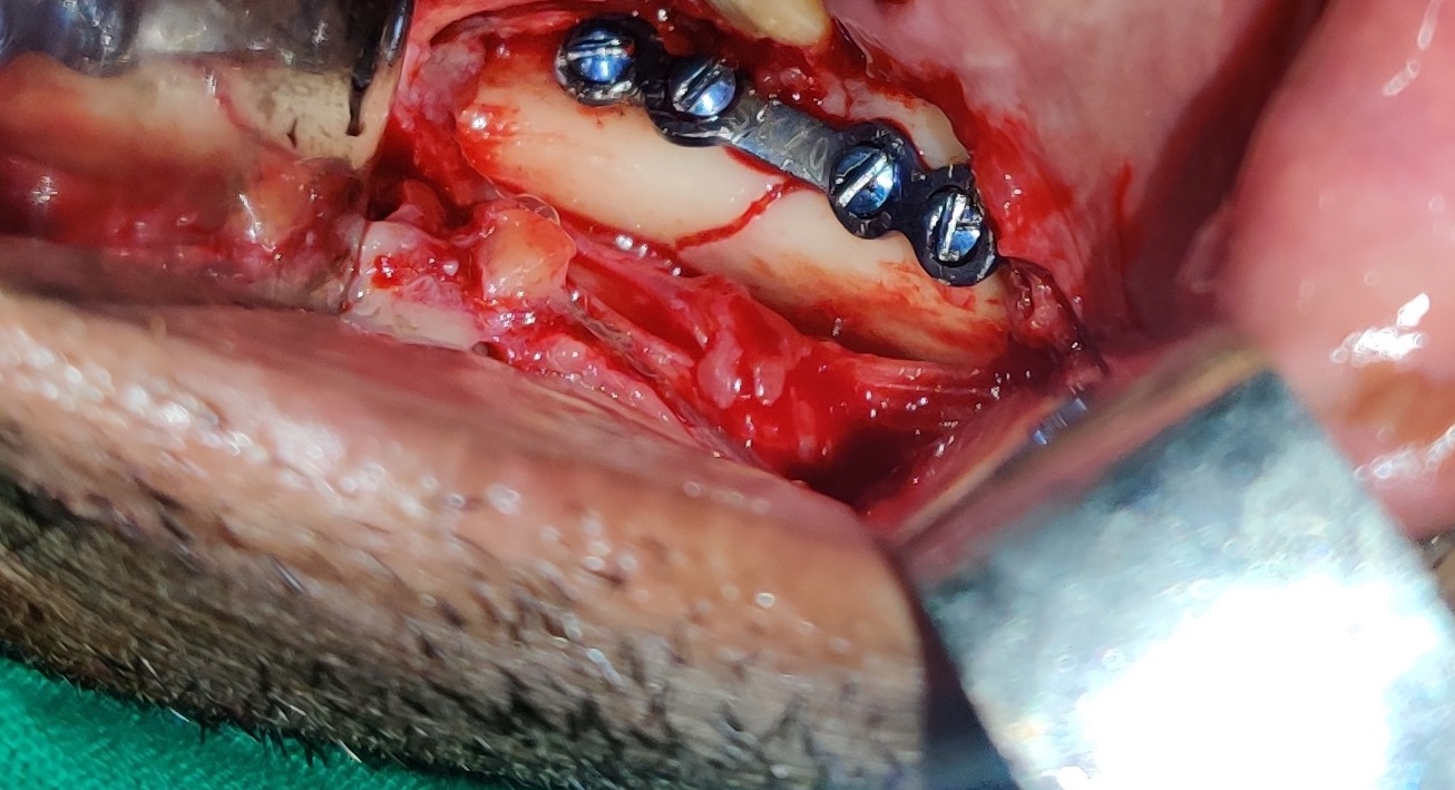 Case 1- Intra-op external oblique ridge plating of fracture site