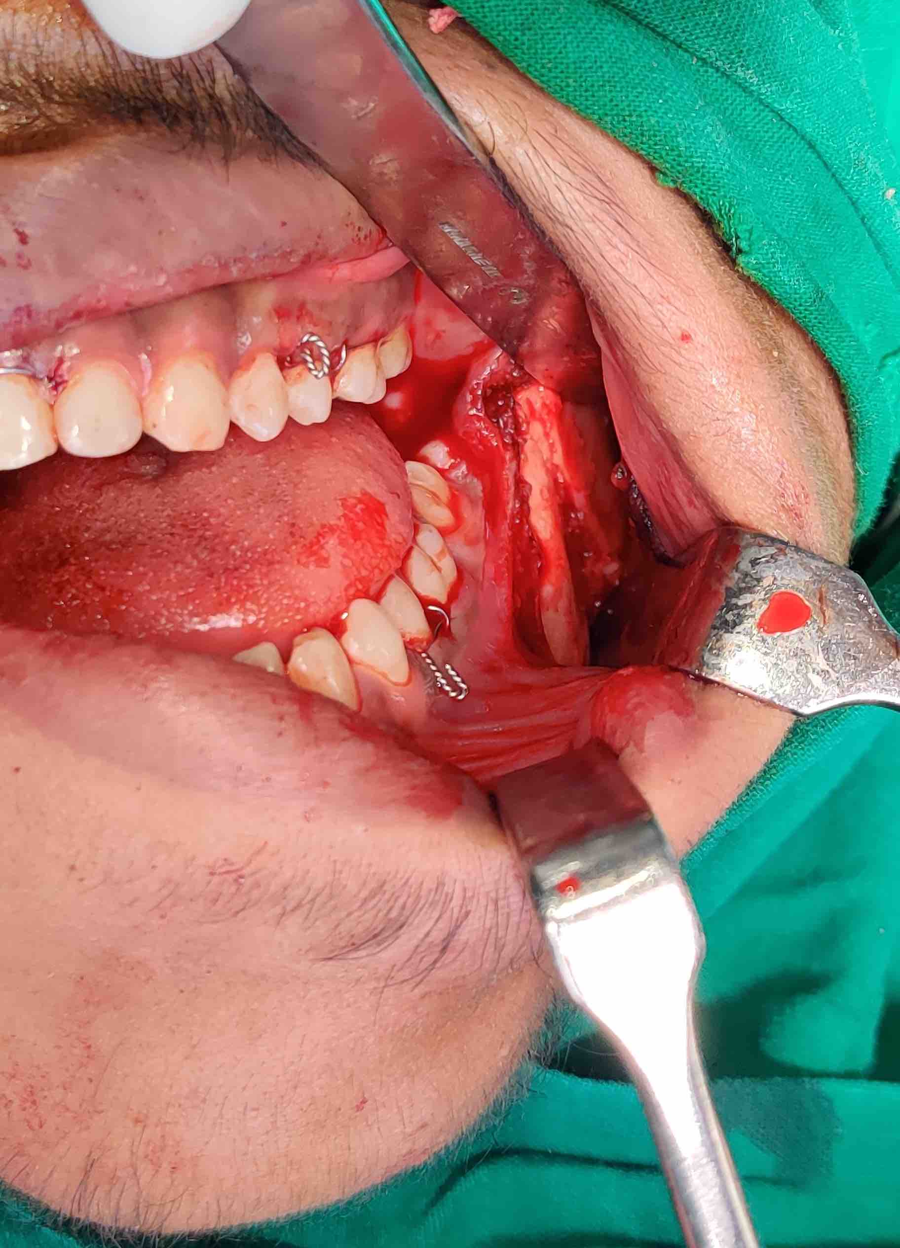 Case 2- Intra-op exposure of fracture site