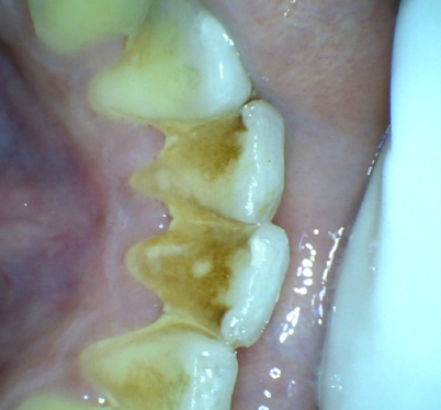 This picture with stains & calculus depicts the poor oral hygiene.