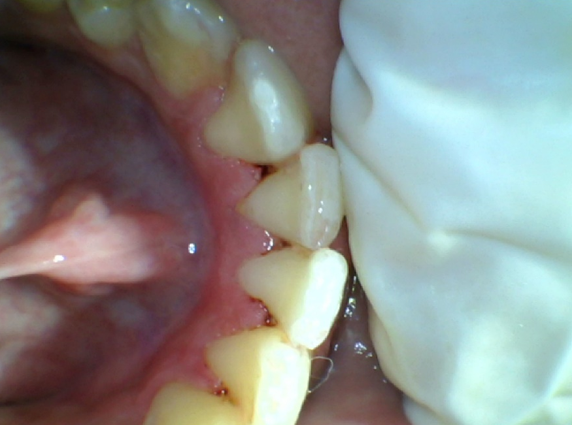 Oralprophylaxis done on 5Th day