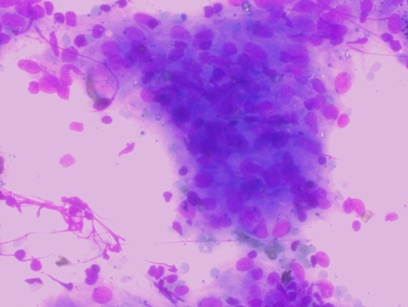 Photomicrograph of BAL with LG stain-SCC (40x)