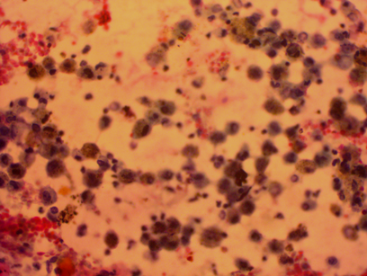 Photomicrograph of BAL with LG stain-Acute inflammation (20x)