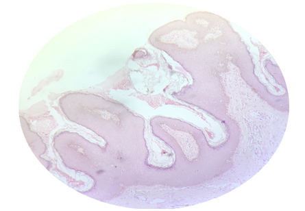 Histopathology of NHNA:hyperkeratotic papillomatous surface (H&E, x40)