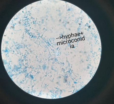 LPCB mount of T.rubrum showing tear drop microconidia