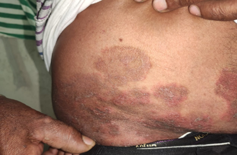 Tinea corporis