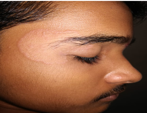 Tinea facaei