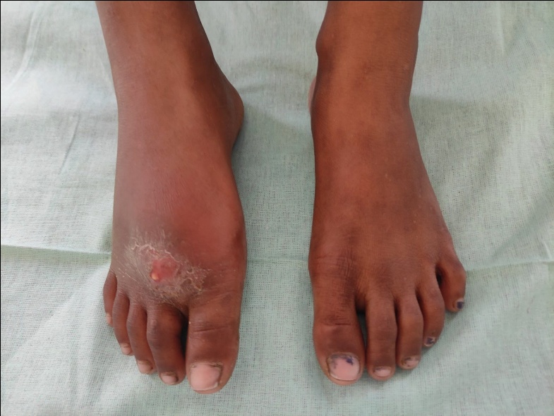 Swelling and discharging sinus over dorsum of right foot.