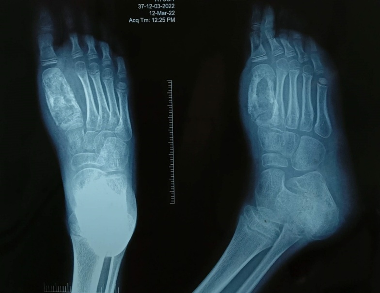 X-ray of right foot showing multipleosteolytic areas involving the first metatarsal with associated surrounding sclerotic changes and areas of cortical thinning and thickening with breach in the cortex at places.