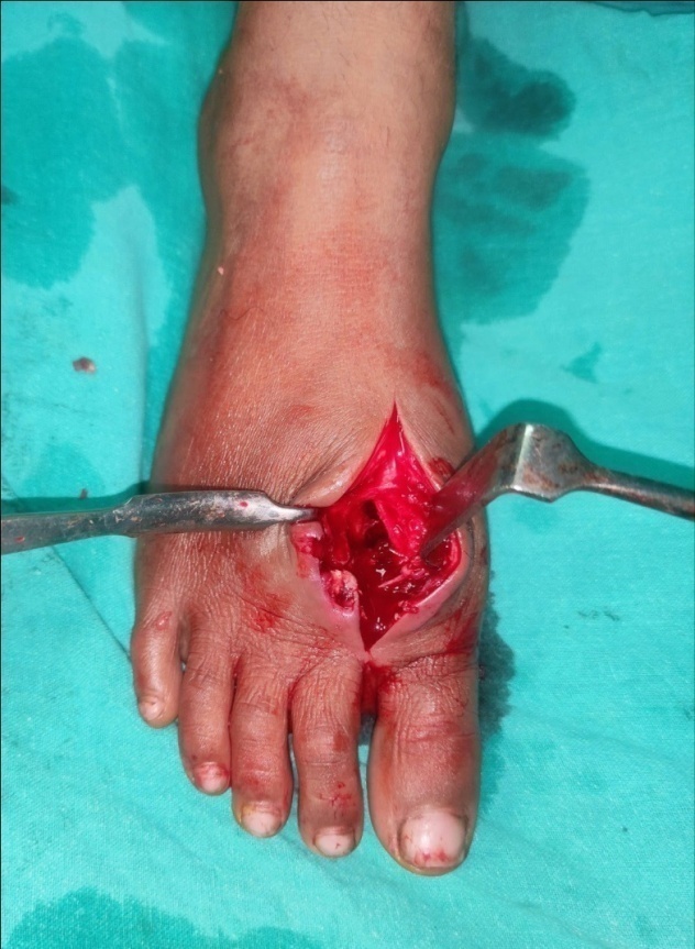 Intra-operative figure showing a linear incision made over the dorsum of the right foot along the first web space with exposed first metatarsal bone and its cavity.