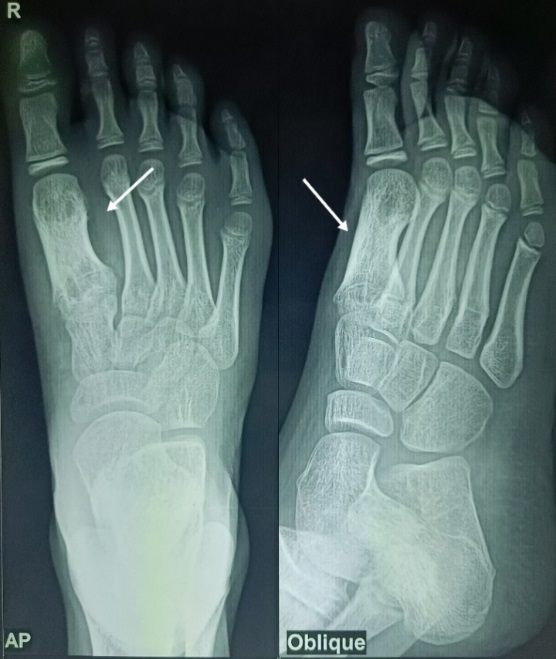 X-ray of right foot showing healed lesion of first metatarsal after 1.5-year follow-up.