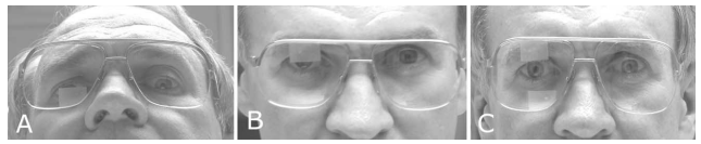 Various position of vertical strip of Scotch Satin tape on the rear surface of the spectacle lens