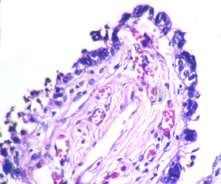 SCOUT - Loss of ciliated cells with secretory cell overgrowth (H&E X400)