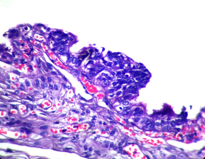 SCOUT - Loss of ciliated cells with epithelial stratification (H&E X400)