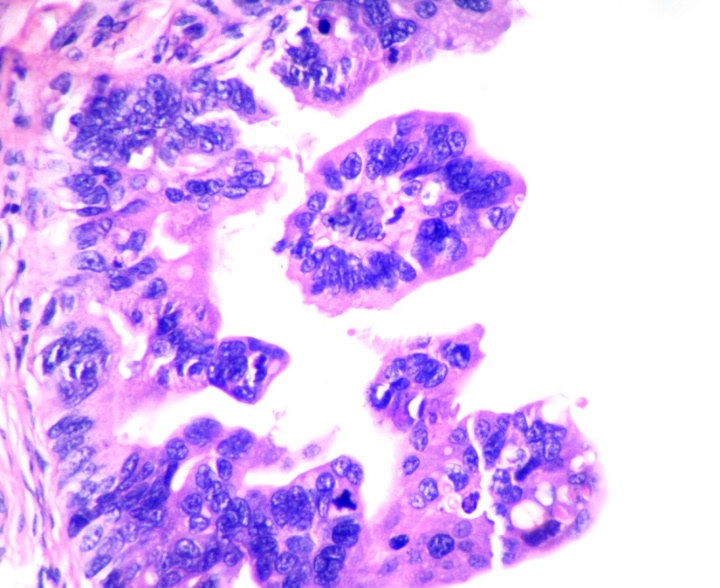 STIC - Nuclear atypia and atypical mitosis in STIC (H&E X400)
