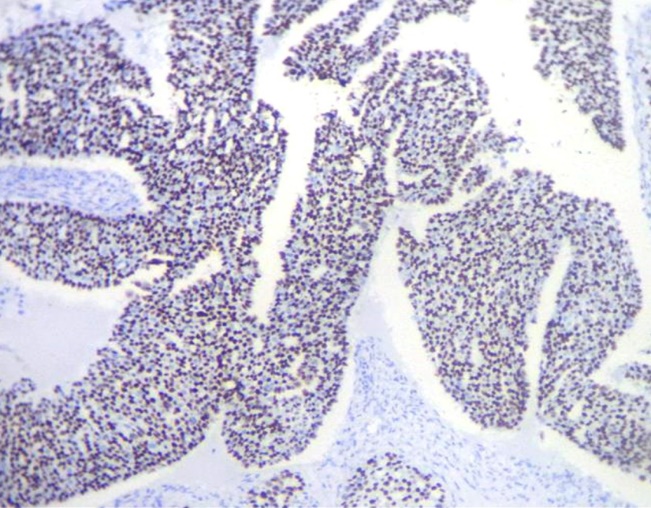p53 Expression in high grade serous tumor (IHC X100)
