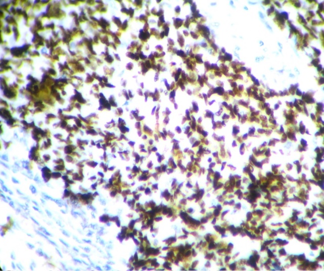Diffuse and strong nuclear expression of p53 in high grade serous tumor (IHC X400)